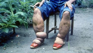Elefantenkrankheit: Beine eines Erkrankten