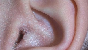 Gehörgangsentzündung mit Ekzem an der Ohrmuschel