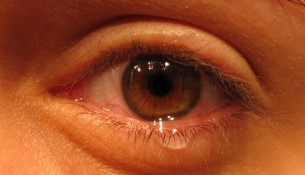 Augengrippe im Umlauf: Hygienemaßnahmen verhindern die Ansteckung!