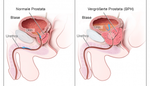 Benigne Prostatahyperplasie - apotheken-wissen.de