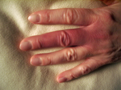Finger mit Morbus Raynaud