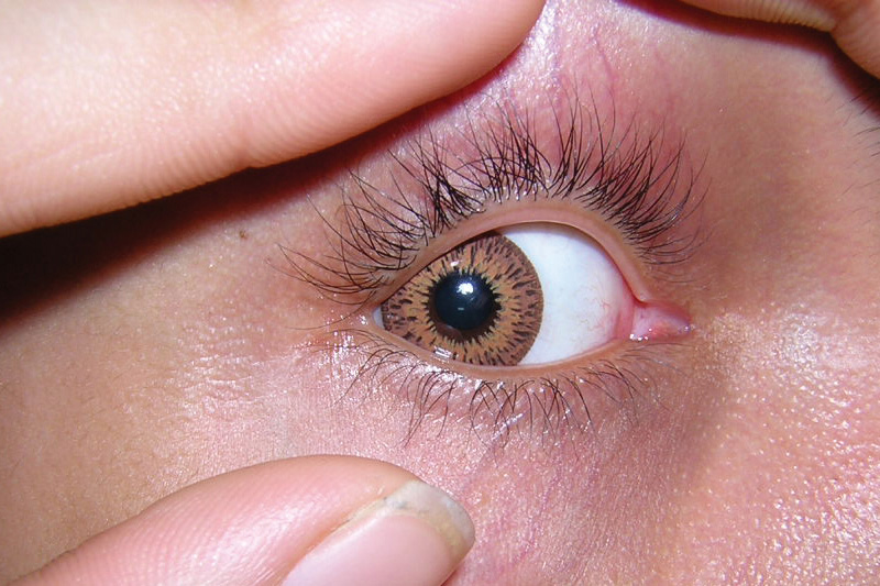 Gelangt ein Fremdkörper ins Auge, befindet er sich meist auf der Oberfläche und lässt sich vorsichtig mit einem Tuch oder durch Spülen des Auges entfernen.