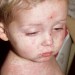 Eine Schutzimpfung gegen Masern ist empfohlen