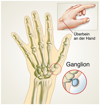 Ganglion / Überbein an der Hand - apotheken-wissen.de