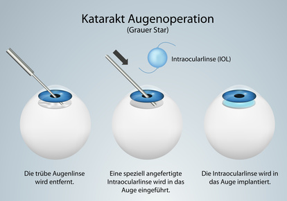 Katarakt Augenoperation gegen den Grauen Star - apotheken-wissen.de