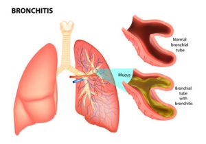 Bronchitis-Infographik