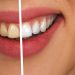 Gepflegte und ungepflegte Zähne