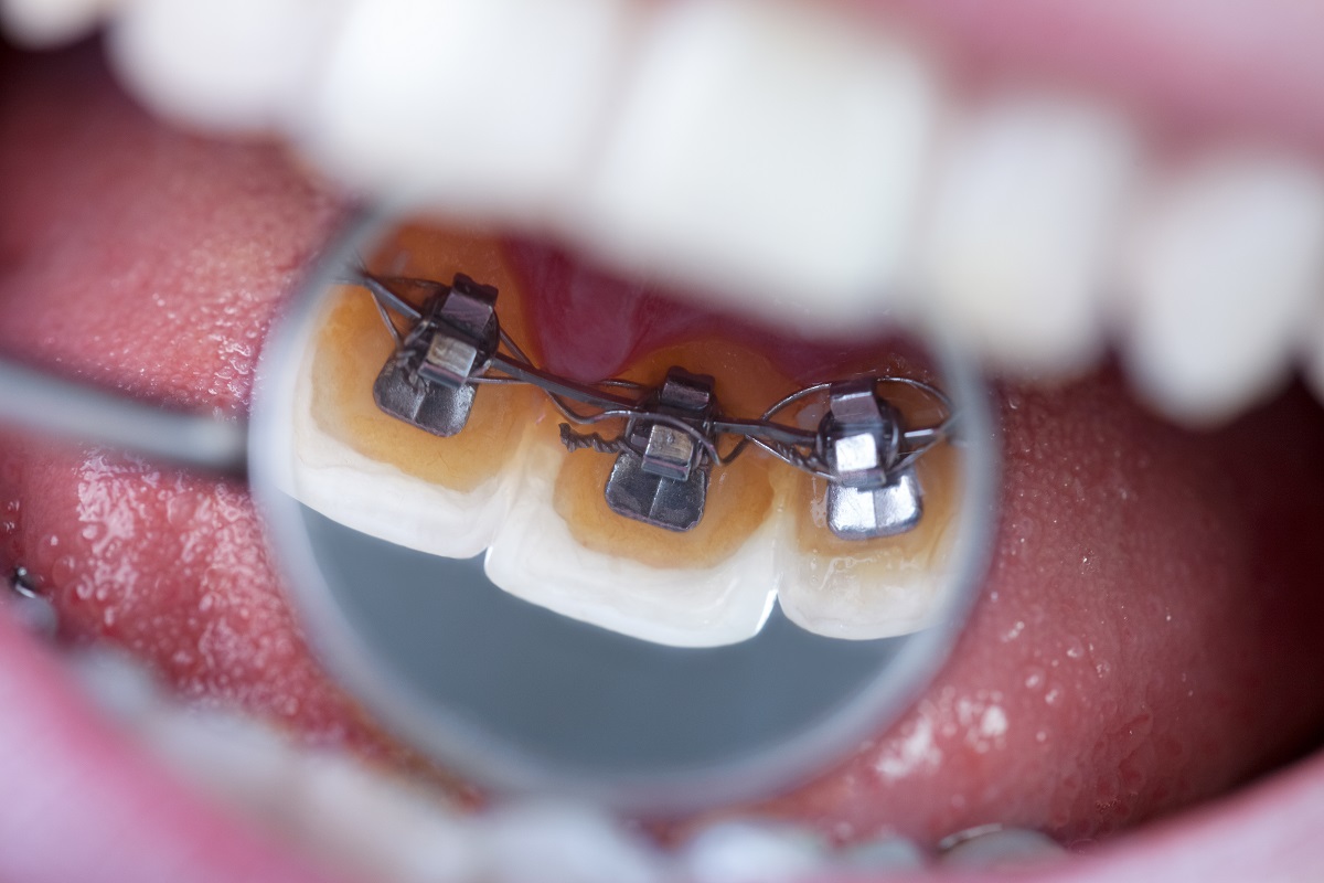 Zahnkorrektur mit lingualer Zahnspange