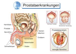 Prostataerkrankungen