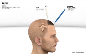Haartransplantation: SDHI Methode